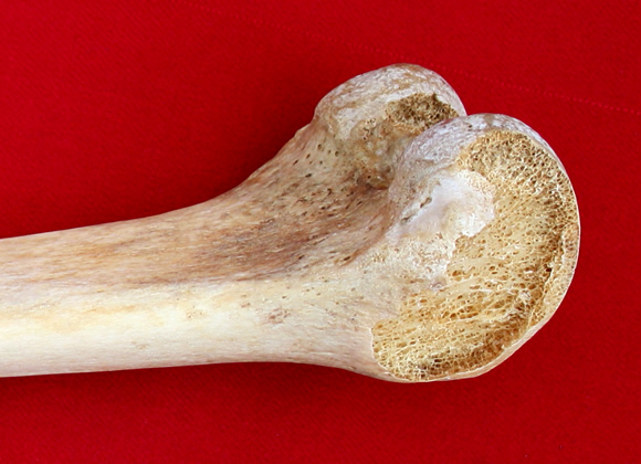 Femur with fragile condyle portions broken off