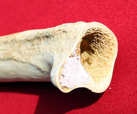 Lesser trochanter of femur opened